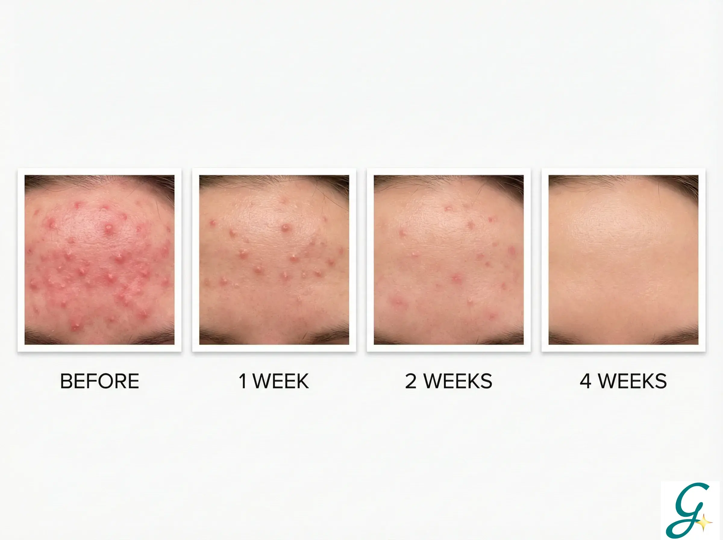 Timeline graphic showing expected improvement at 1 week, 2 weeks, and 4 weeks of treatment