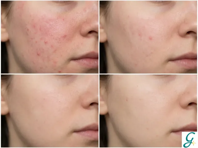Side-by-side before/after photos showing skin improvement over 3 months