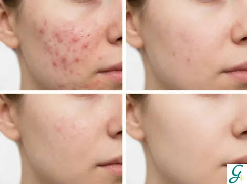 Banish Blemishes: Your Guide to Clear and Healthy Skin